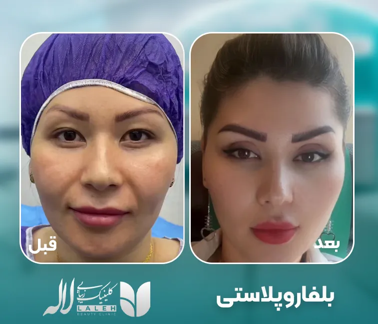 بلفاروپلاستی