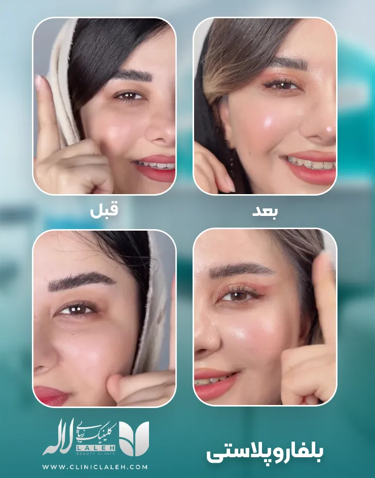 بلفاروپلاستی