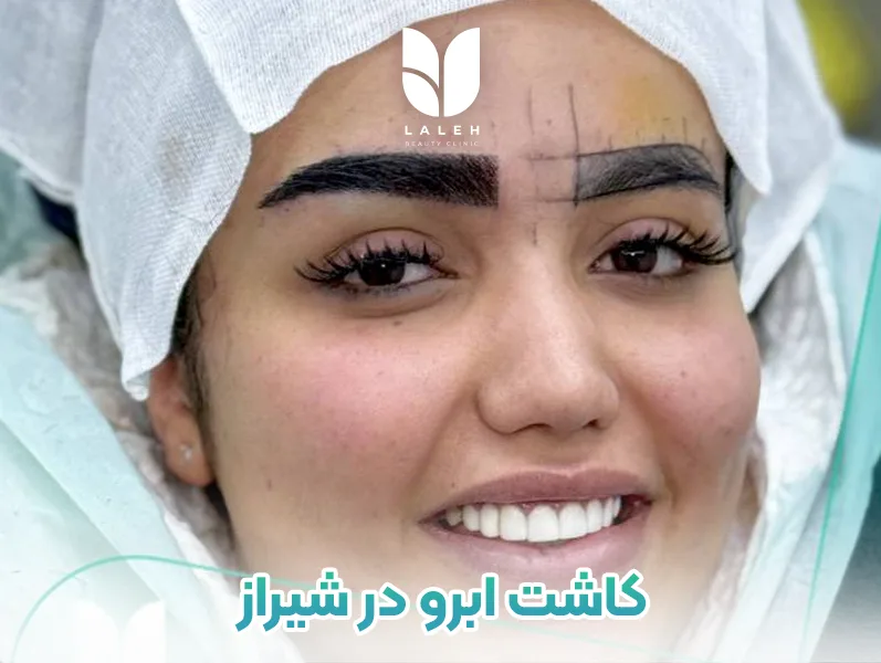 کاشت ابرو در شیراز