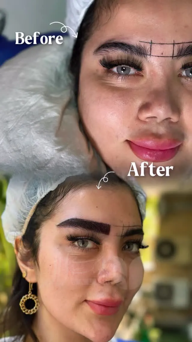 قبل و بعد کاشت ابرو FIT