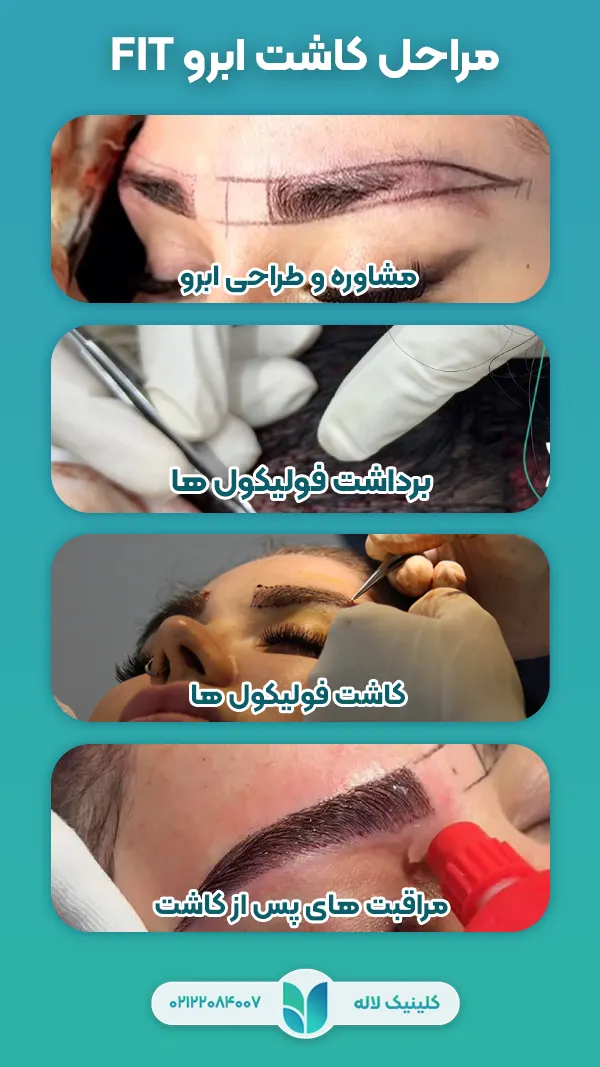 مراحل کاشت ابرو به روش FIT