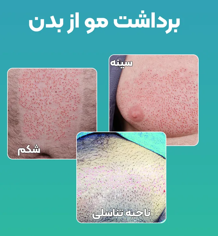 برداشت مو از ناحیه تناسلی