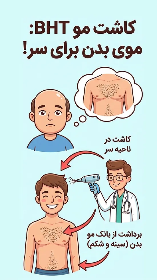 کاشت مو به روش BHT