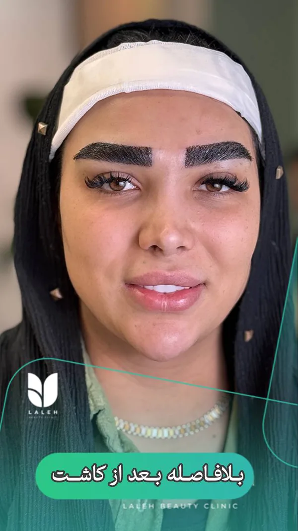 کاشت ابرو کلینیک لاله