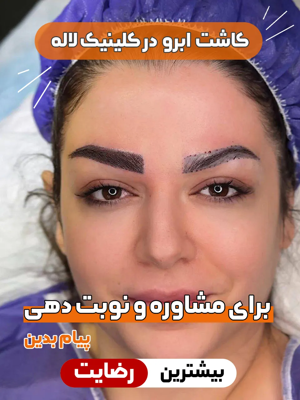 کاشت ابرو