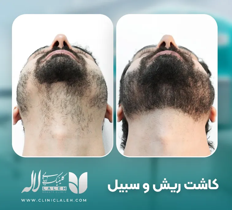 کاشت ریش و سبیل
