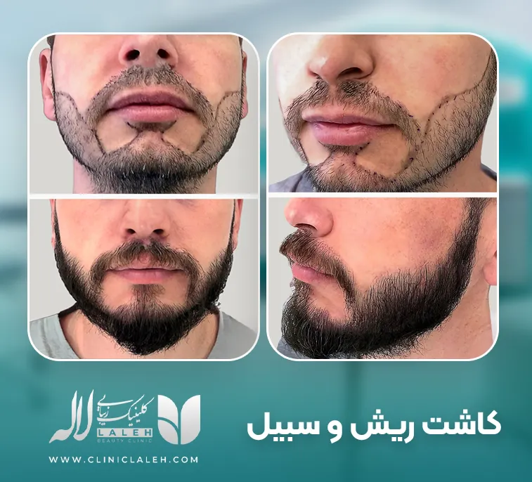 کاشت ریش و سبیل