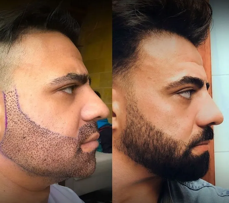 کاشت ریش و سبیل