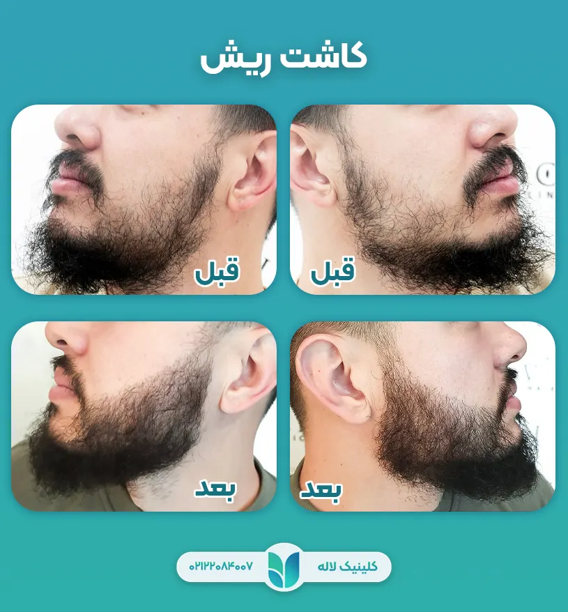 کاشت ریش و سبیل