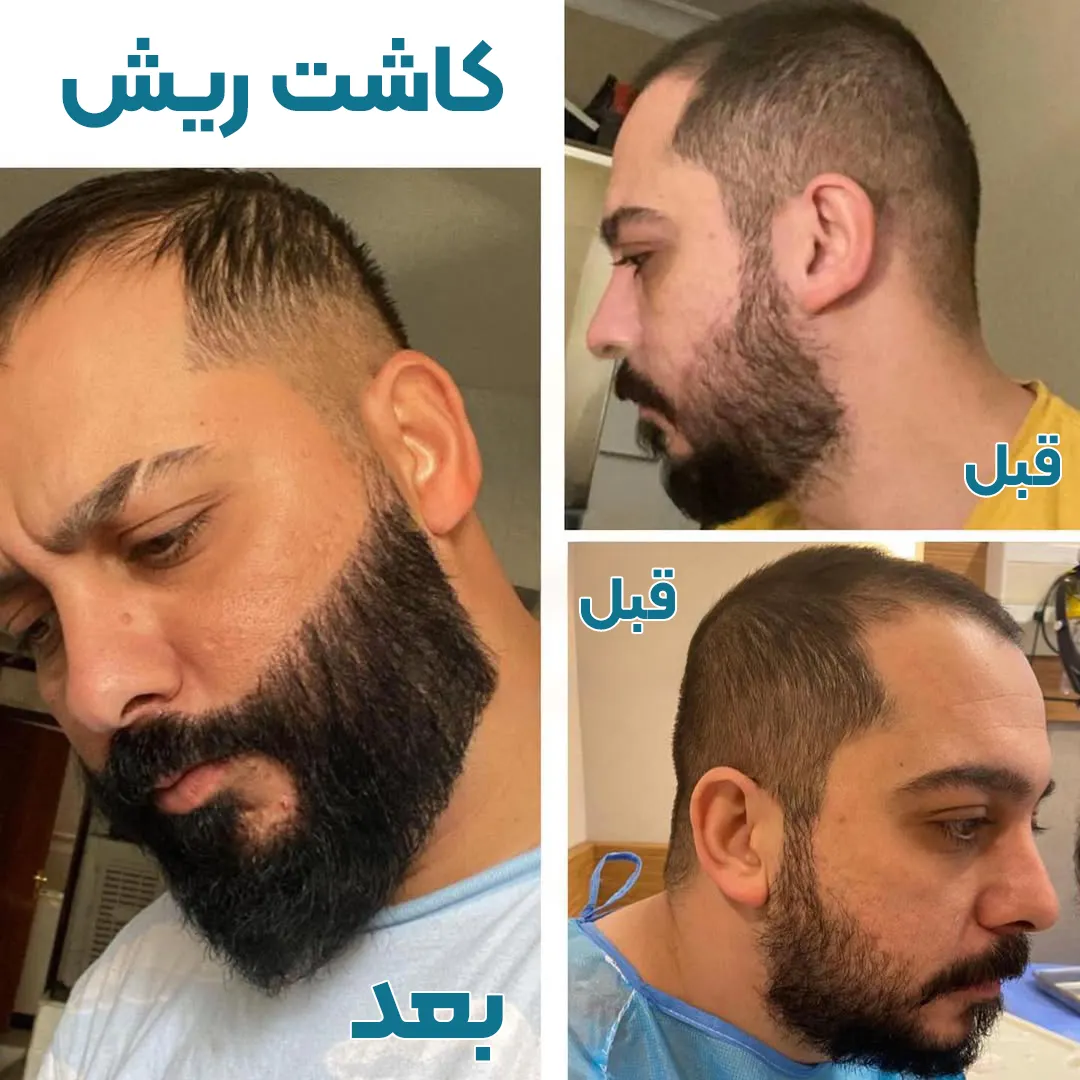 کاشت ریش و سبیل