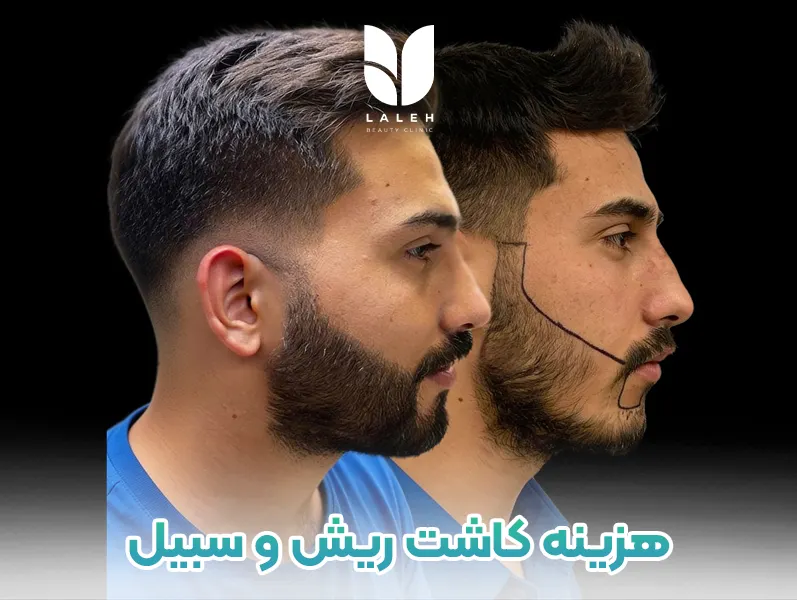 کاشت ریش و سبیل
