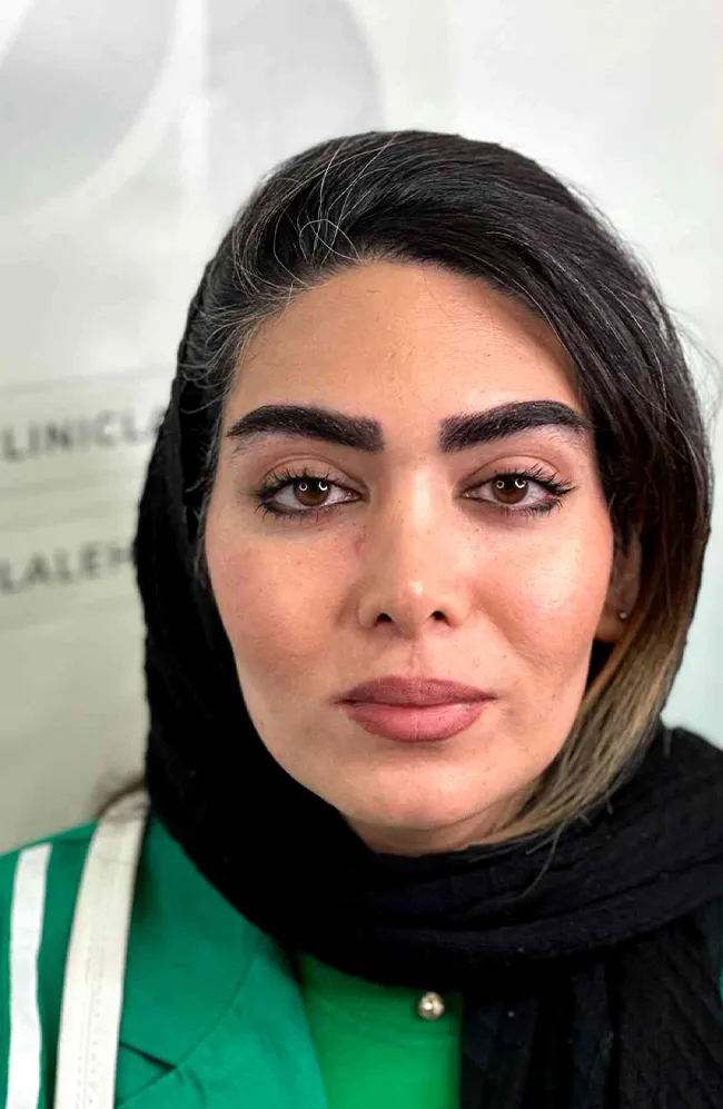کاشت ابرو لاله