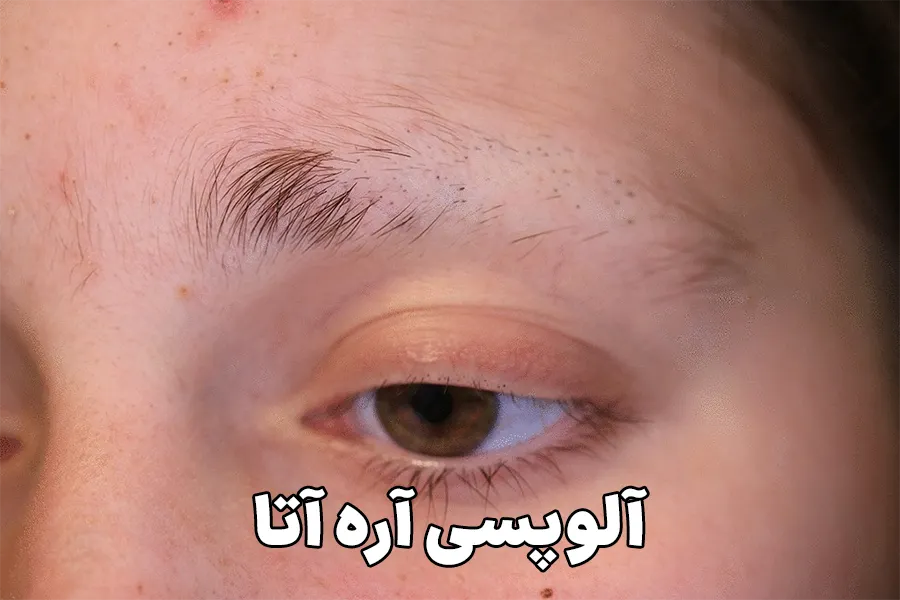 آلوپسی آره آتا