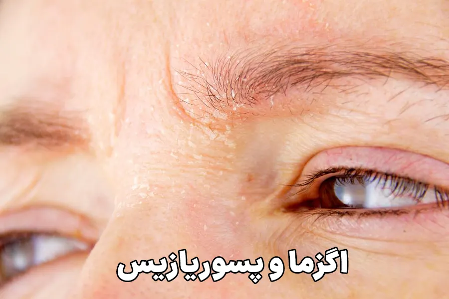 اگزما و پسوریازیس