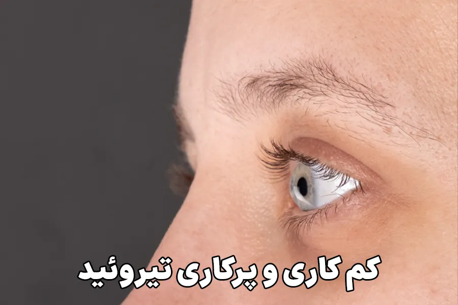کم کاری و پرکاری تیروئید
