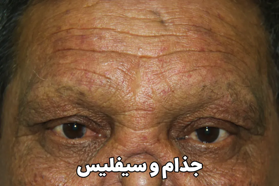 جذام و سیفلیس