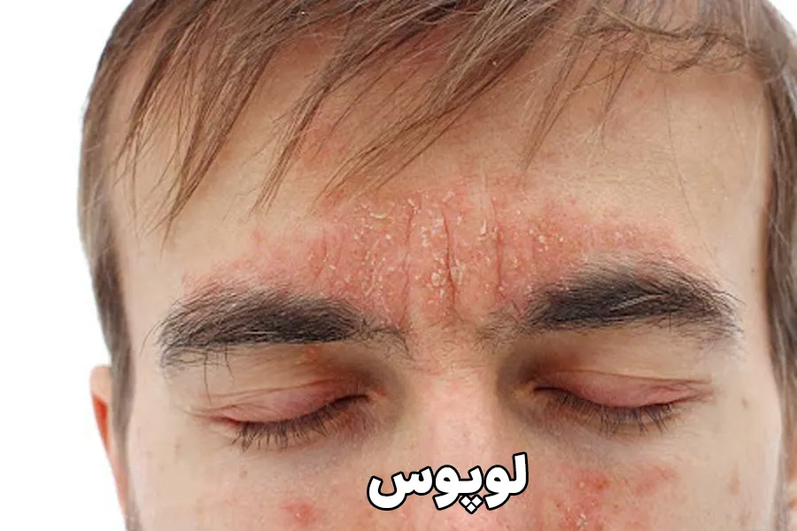 لوپوس