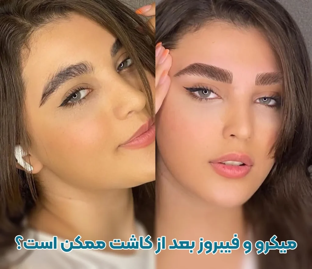 میکروبلیدینگ و فیبروز بعد از کاشت ابرو 