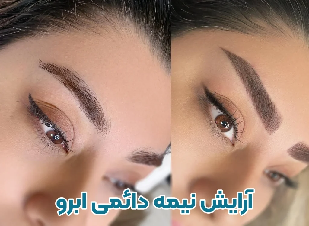 میکروبلیدینگ و فیبروز