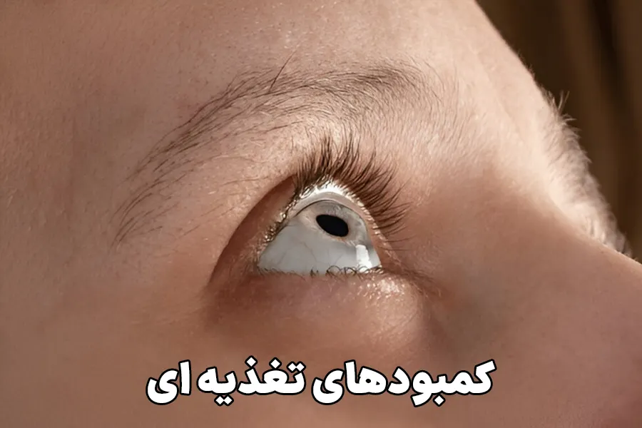 کمبودهای تغذیه ای
