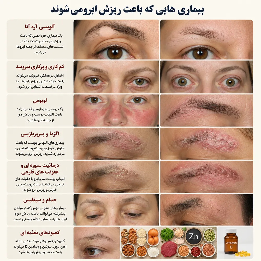 بیماری هایی که باعث ریزش ابرو می شوند