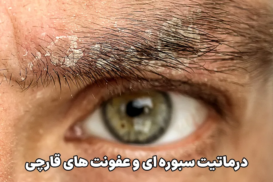 درماتیت سبوره ای و عفونت های قارچی
