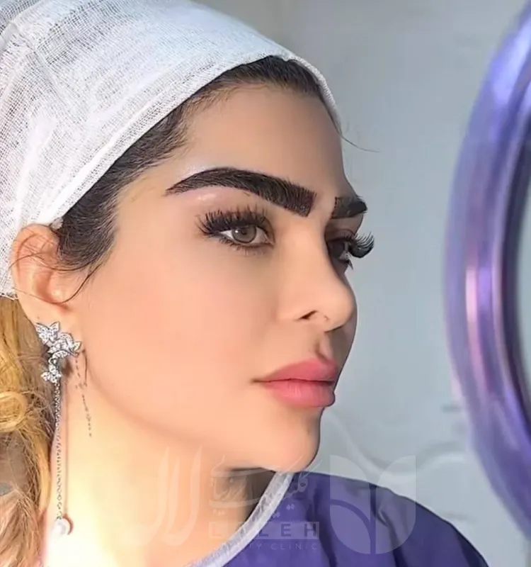 کاشت ابرو
