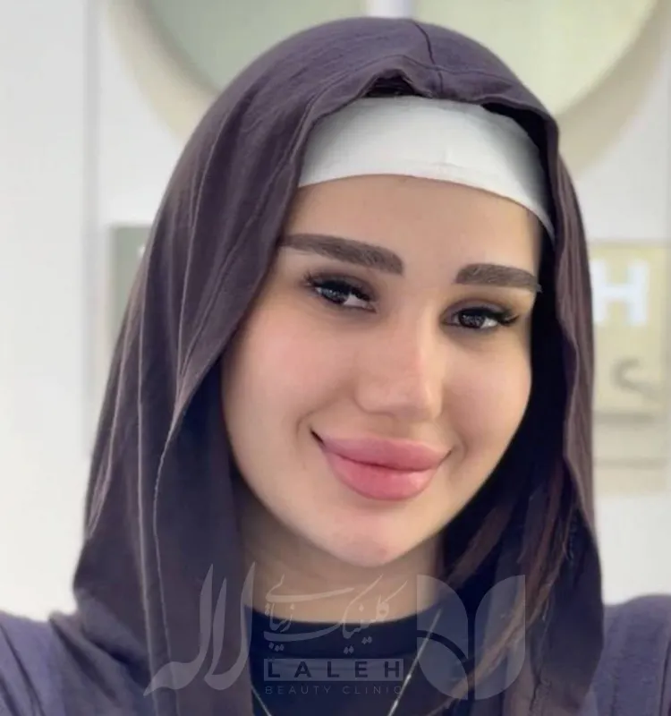 کاشت ابرو