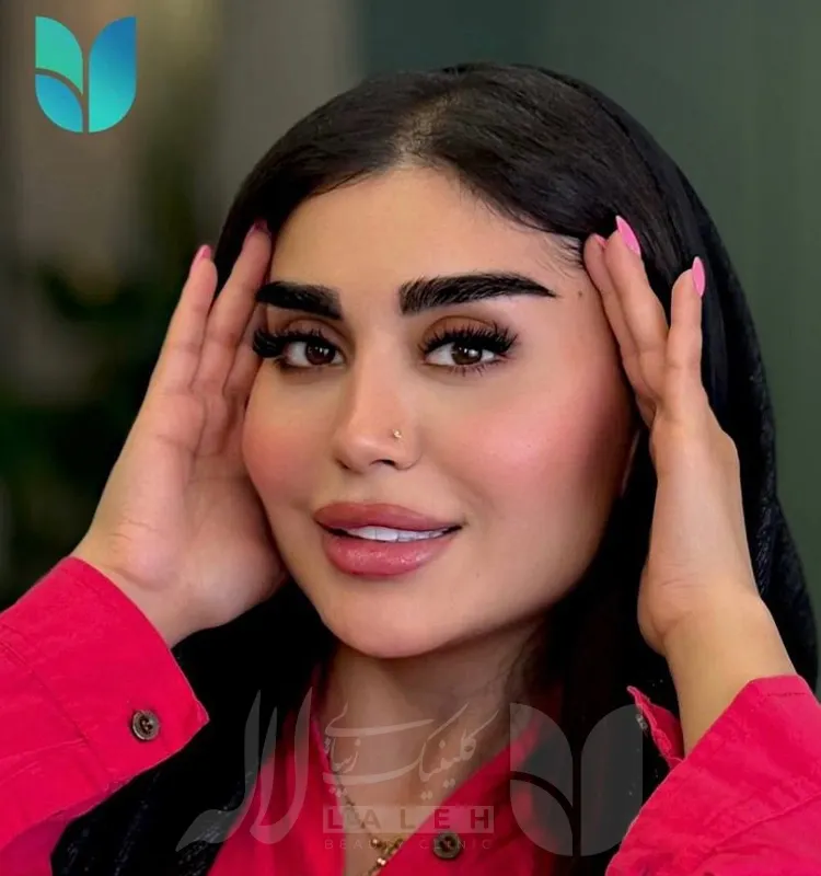 کاشت ابرو