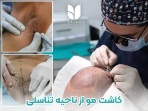 چرا کاشت مو از ناحیه تناسلی و زیر بغل مناسب نیست؟