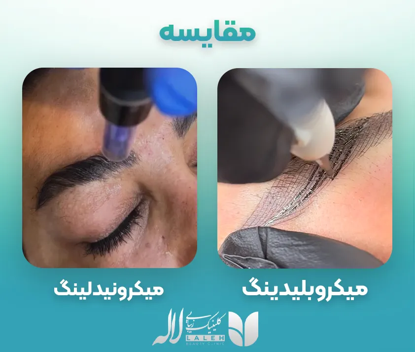 تفاوت میکرونیدلینگ ابرو با میکروبلیدینگ ابرو