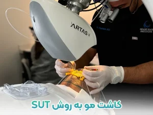 کاشت مو به روش SUT