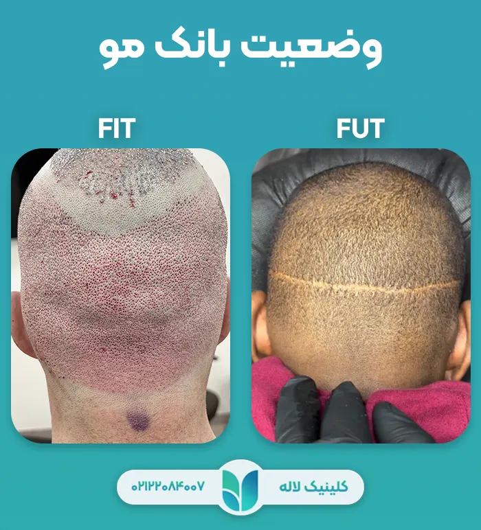 مقایسه کاشت مو با جراحی FUT و روش بدون جراحی FIT