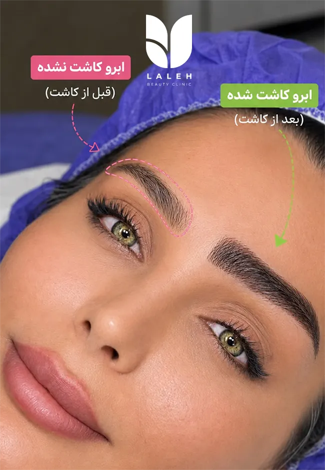 کاشت ابرو 