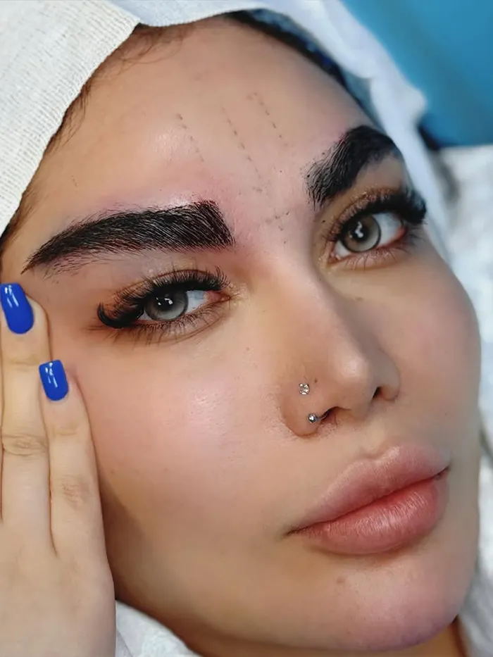 کاشت ابرو