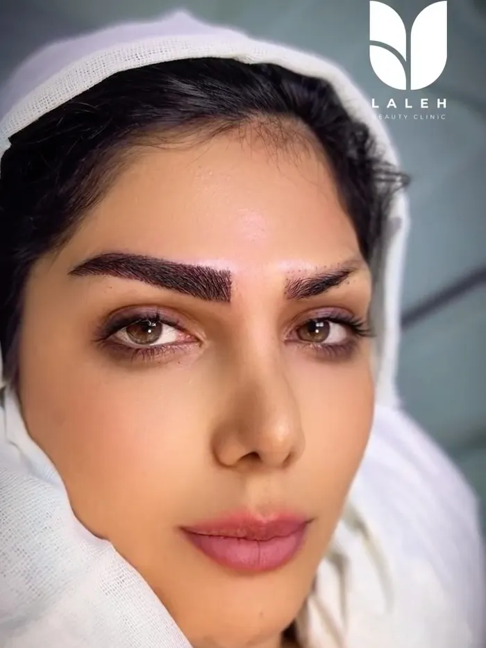 کاشت ابرو