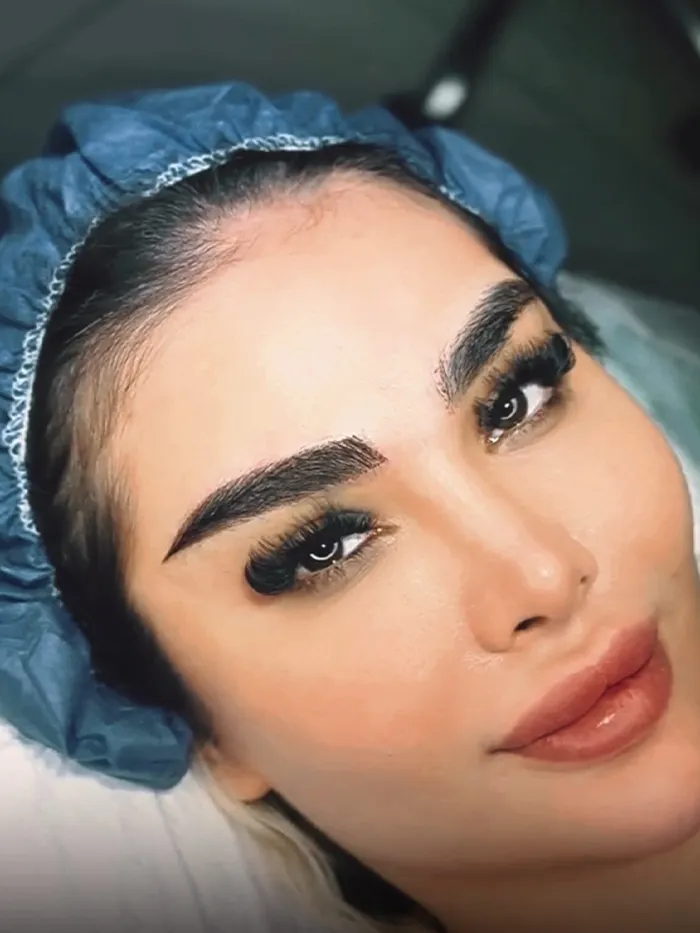 کاشت ابرو