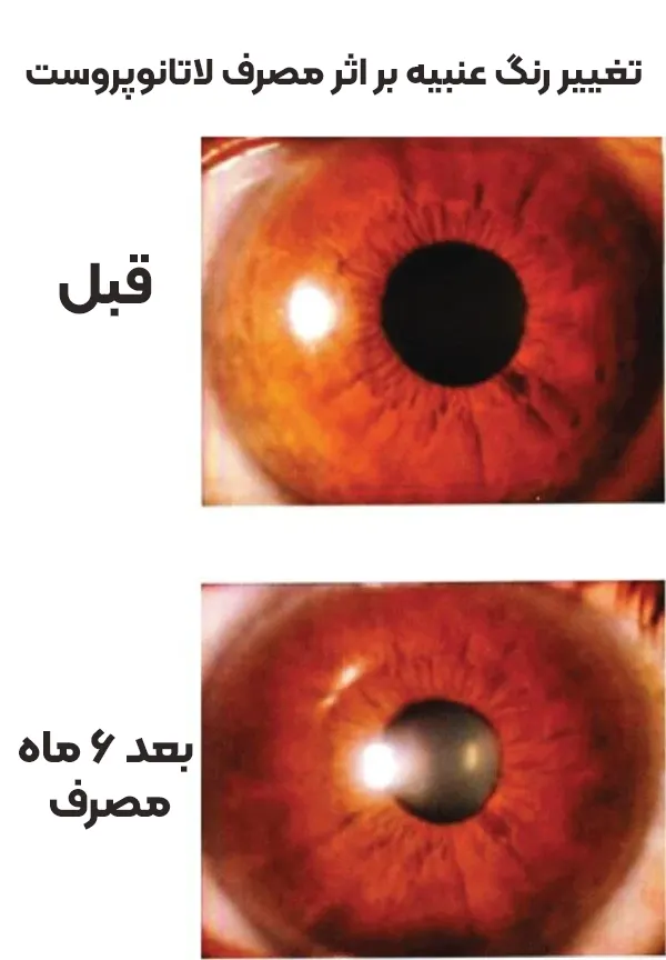 تغییر رنگ عنبیه لاتانوپروست
