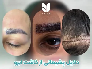 پشیمانی از کاشت ابرو