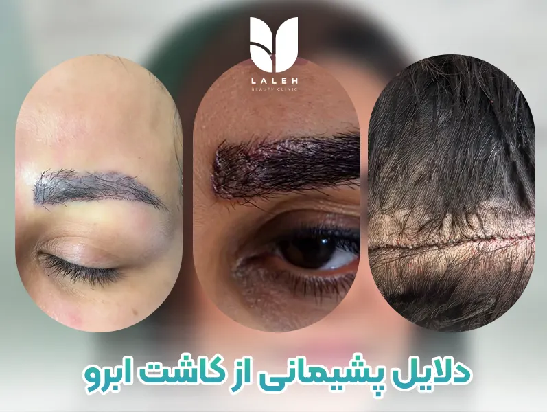 پشیمانی از کاشت ابرو