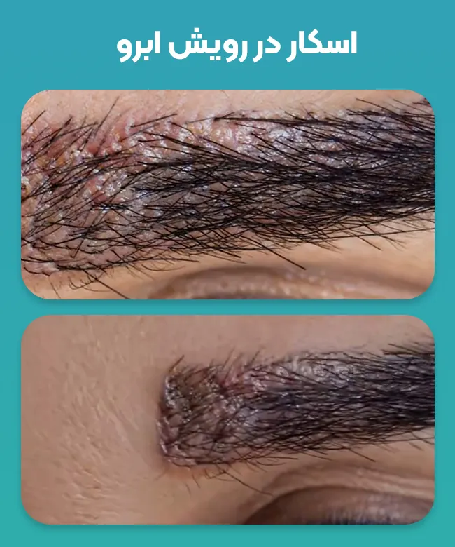 اسکار نقطه ای در ابرو