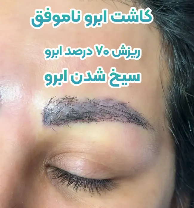 تراکم کم و سیخ شدن ابرو بعد کاشت