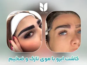کاشت ابرو با موی نازک و ضخیم