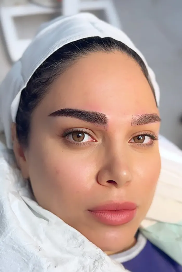کاشت ابرو